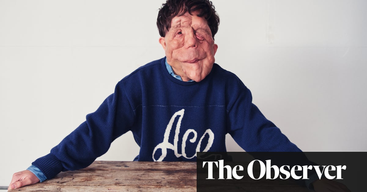 Overcoming Adversity, Adam Pearson Shines as a Hollywood Star